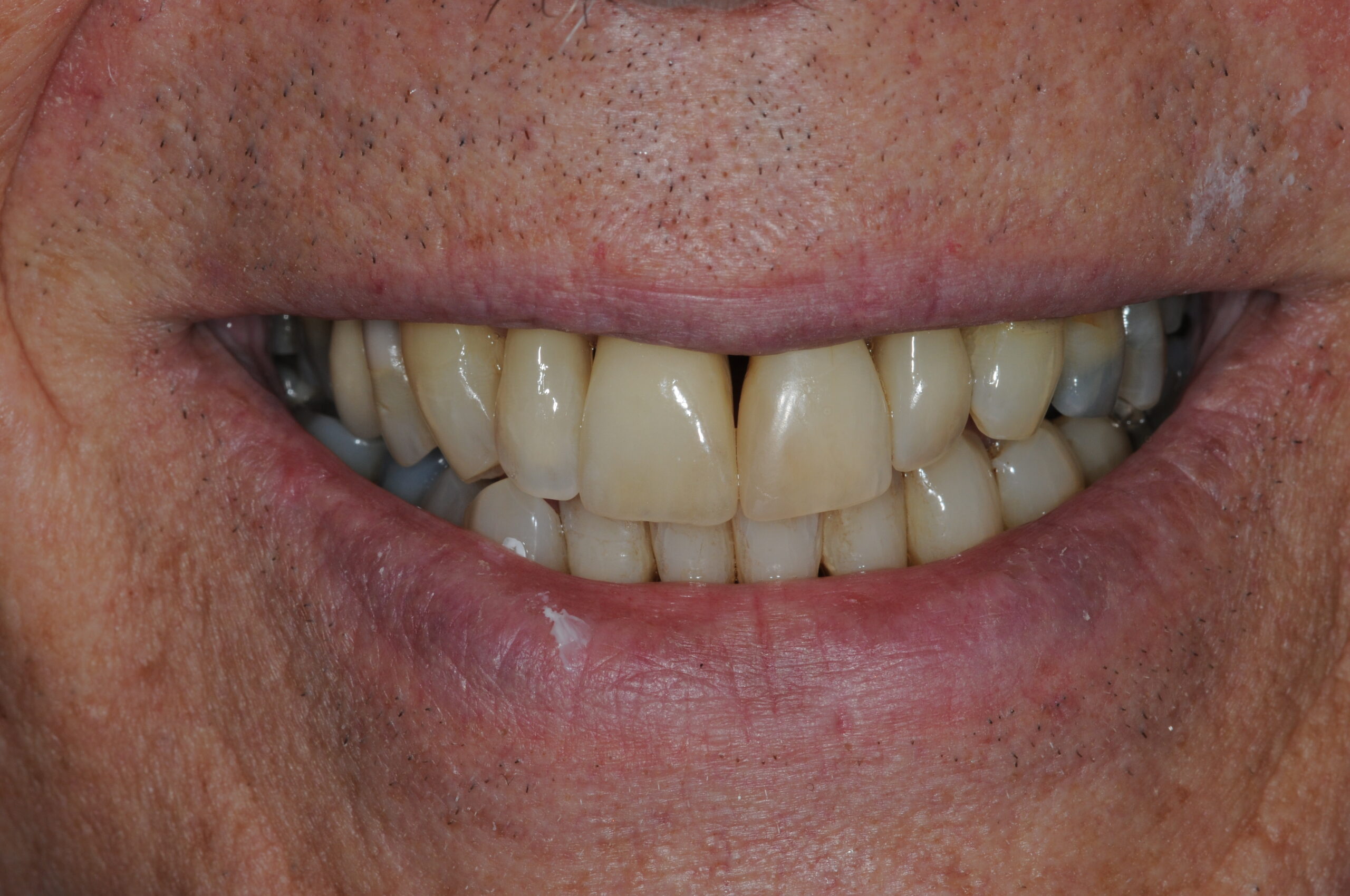 Couronne sur implant 11