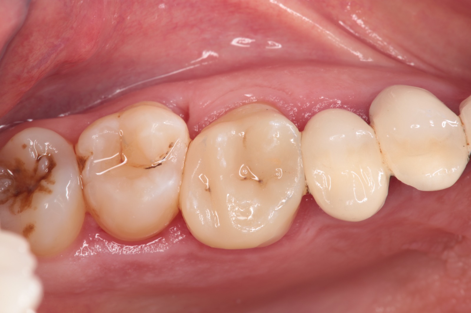 Overlay 16 apre╠Çs restauration