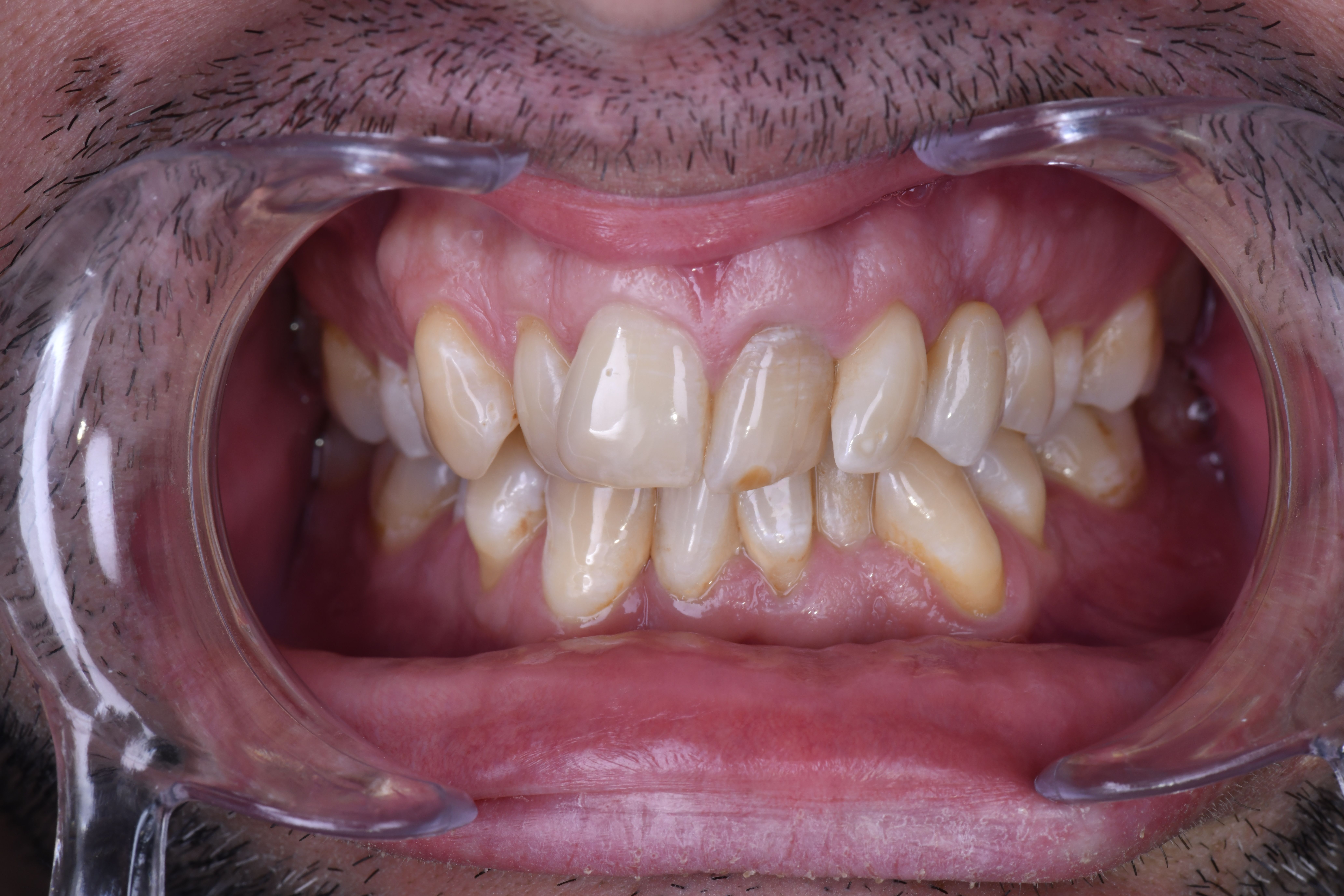 Pont colle╠ü 23 apre╠Çs restauration