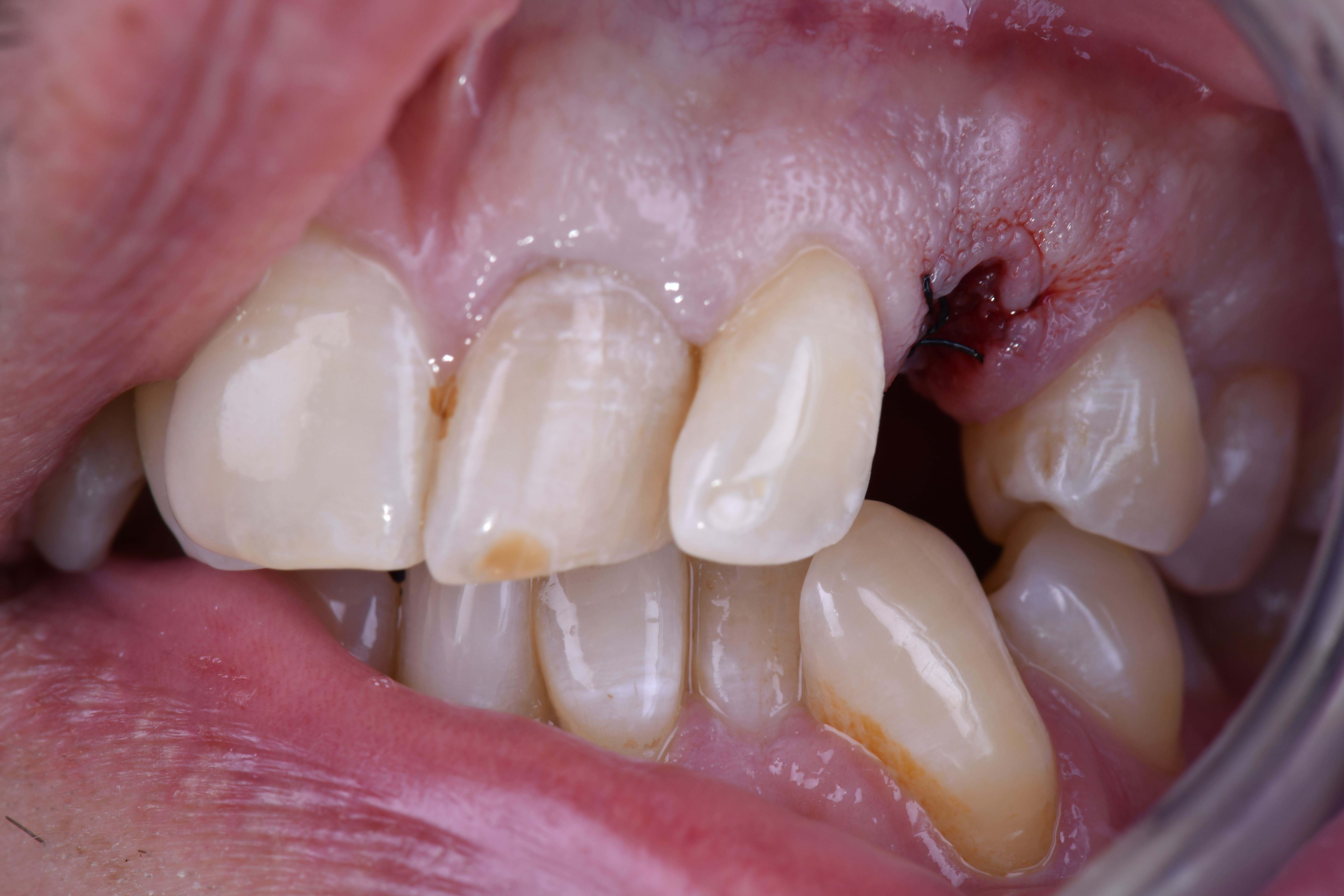 Pont colle╠ü 23 avant restauration