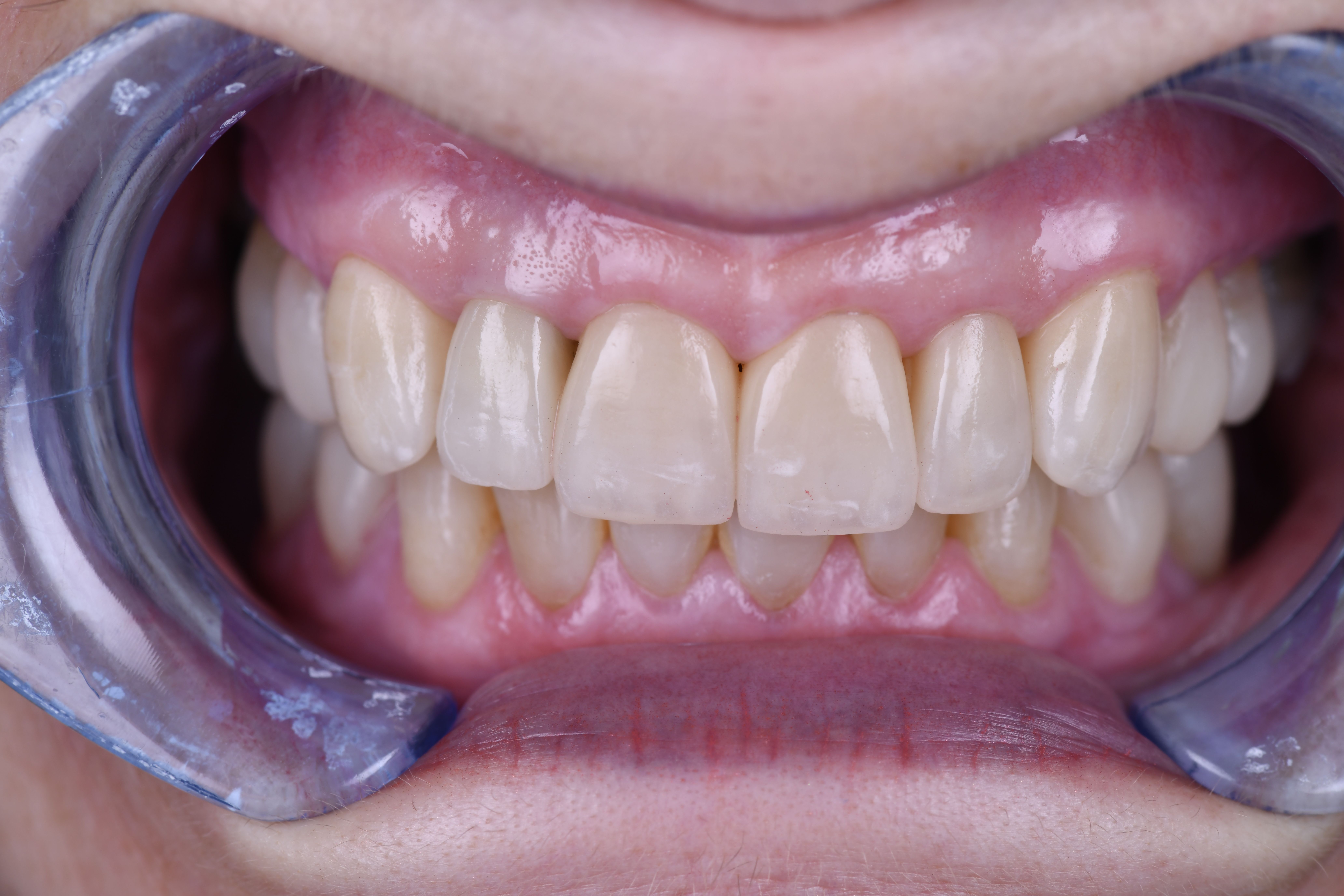 Situation finale apre╠Çs pose de facettes_