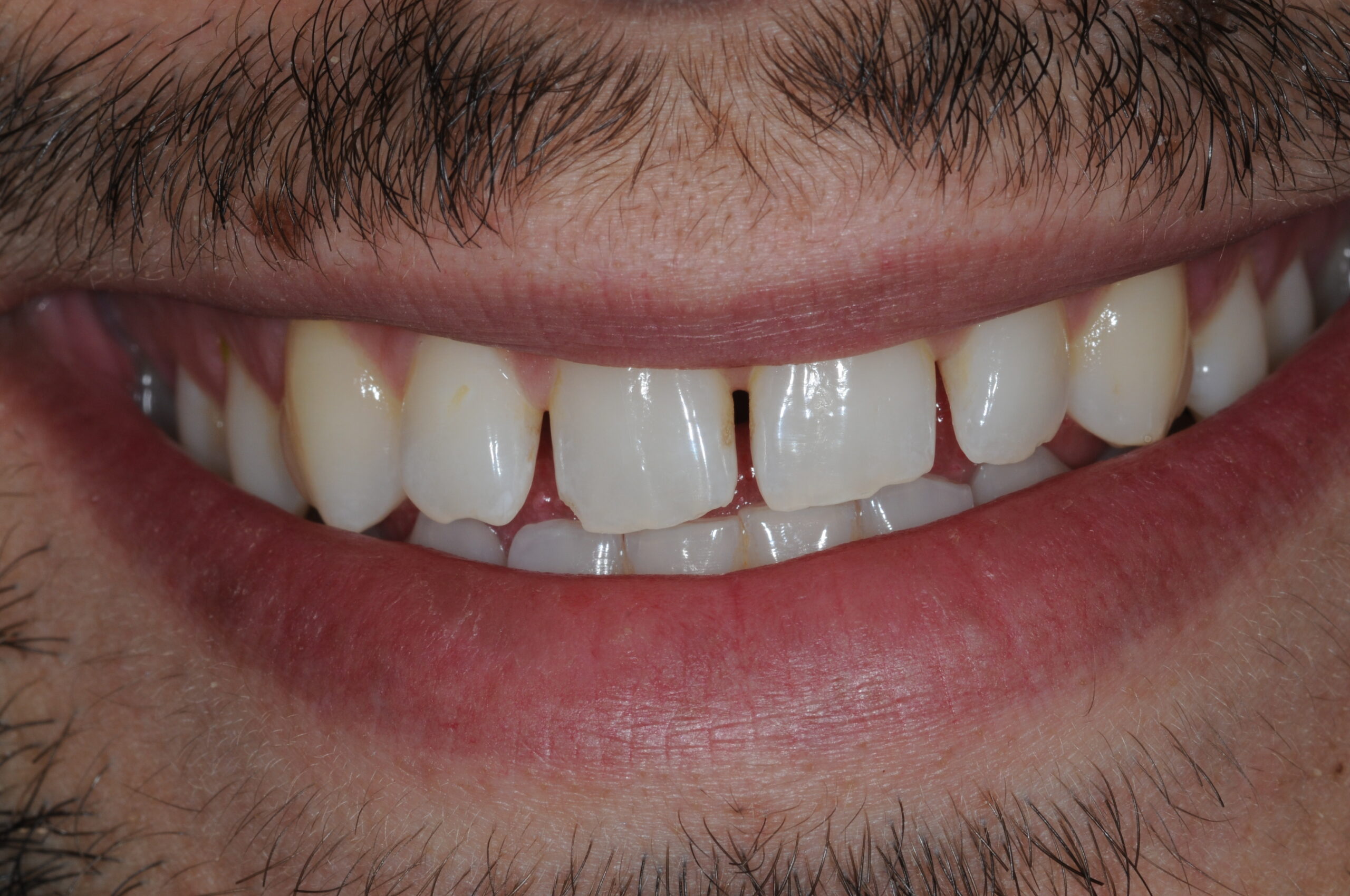 Situation initiale avant facettes