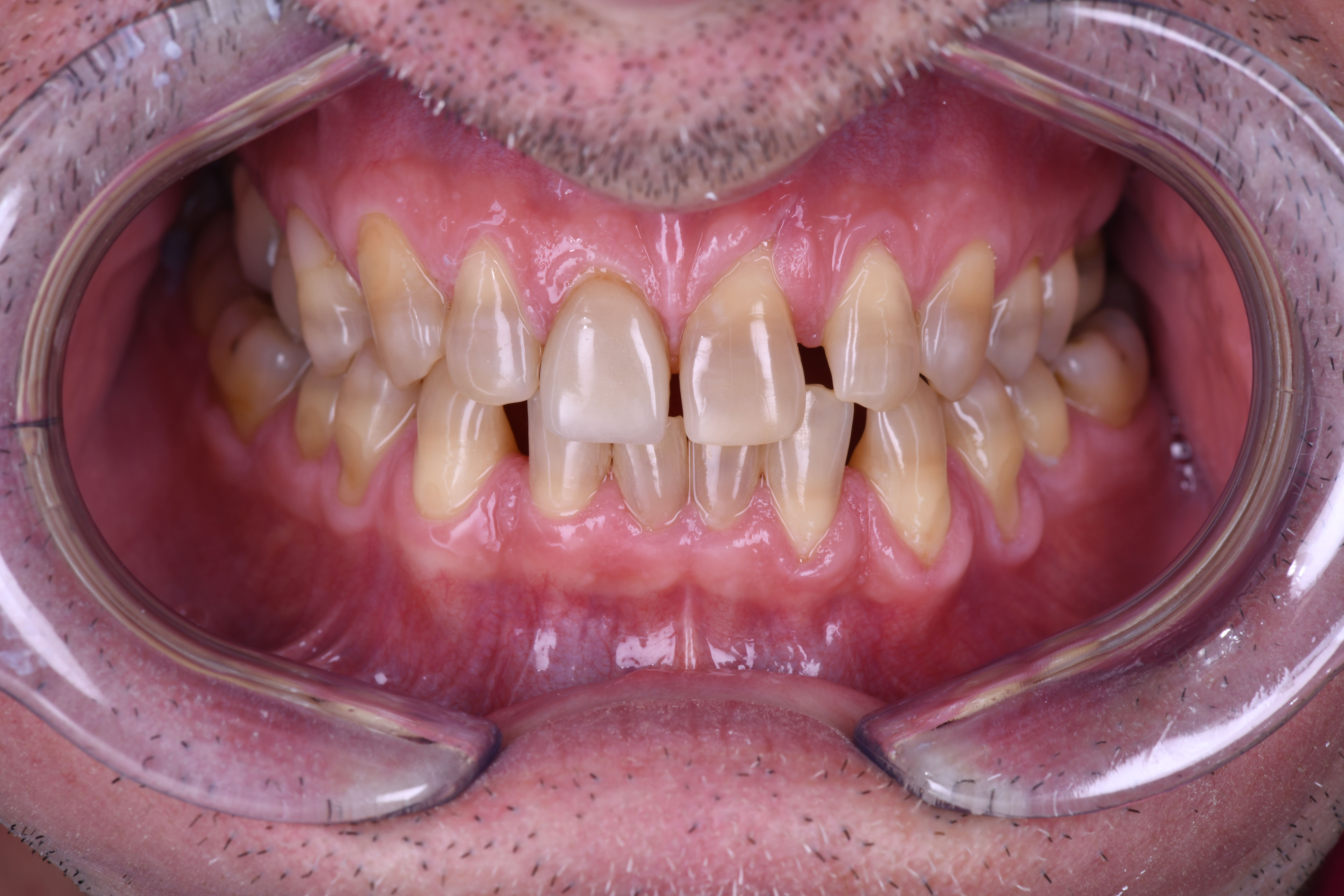 Situation initiale avant restauration comple╠Çte haut et bas