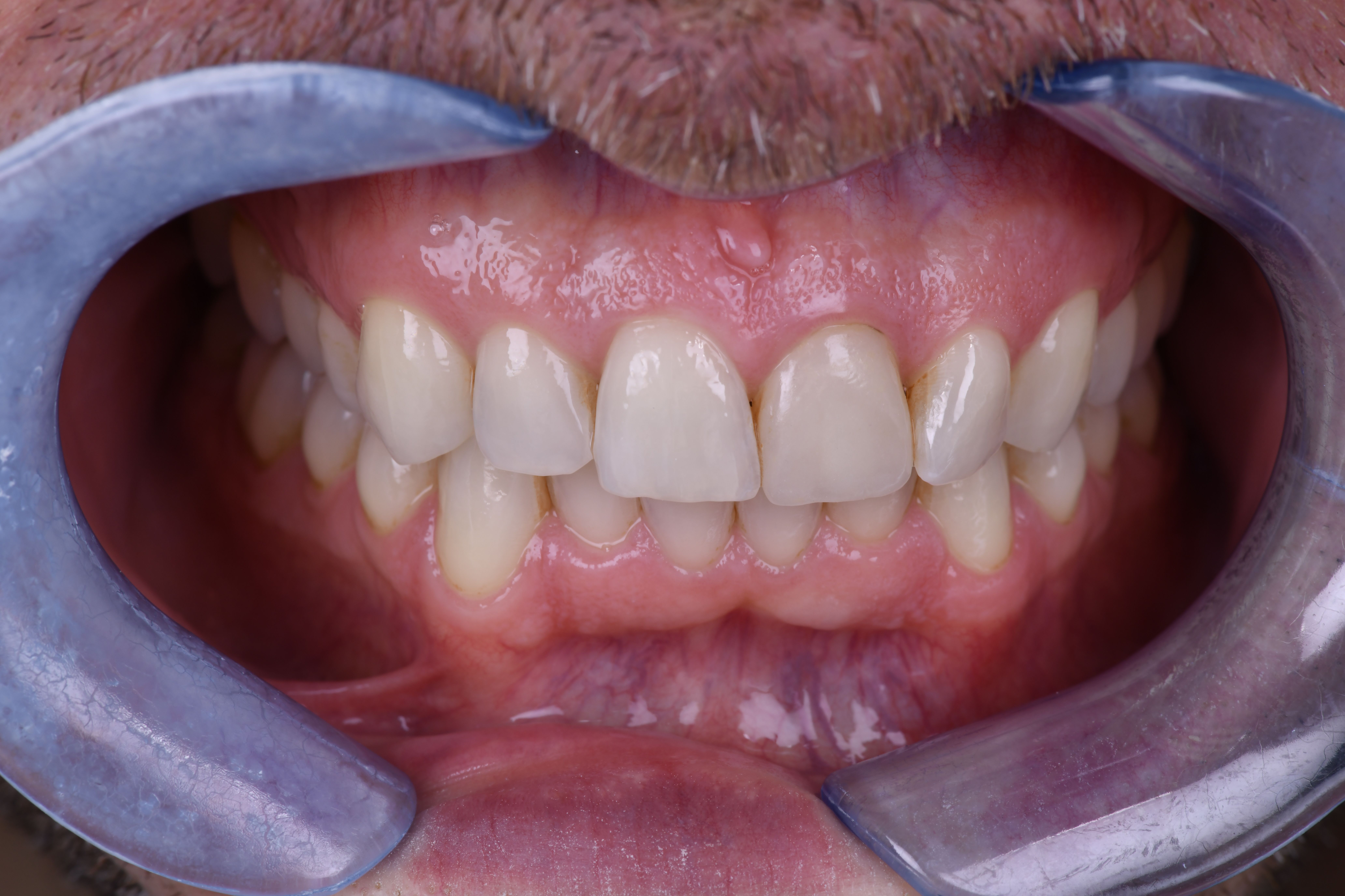 Situation initiale couronne 21