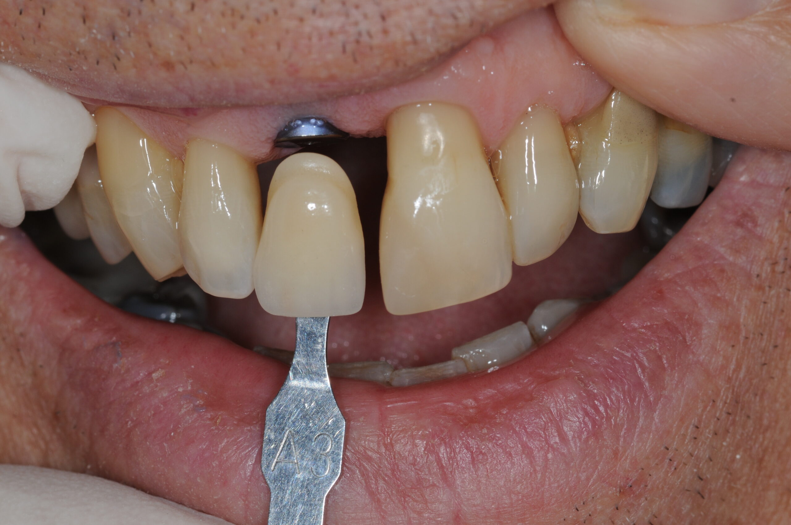 Situation initiale implant sur 11