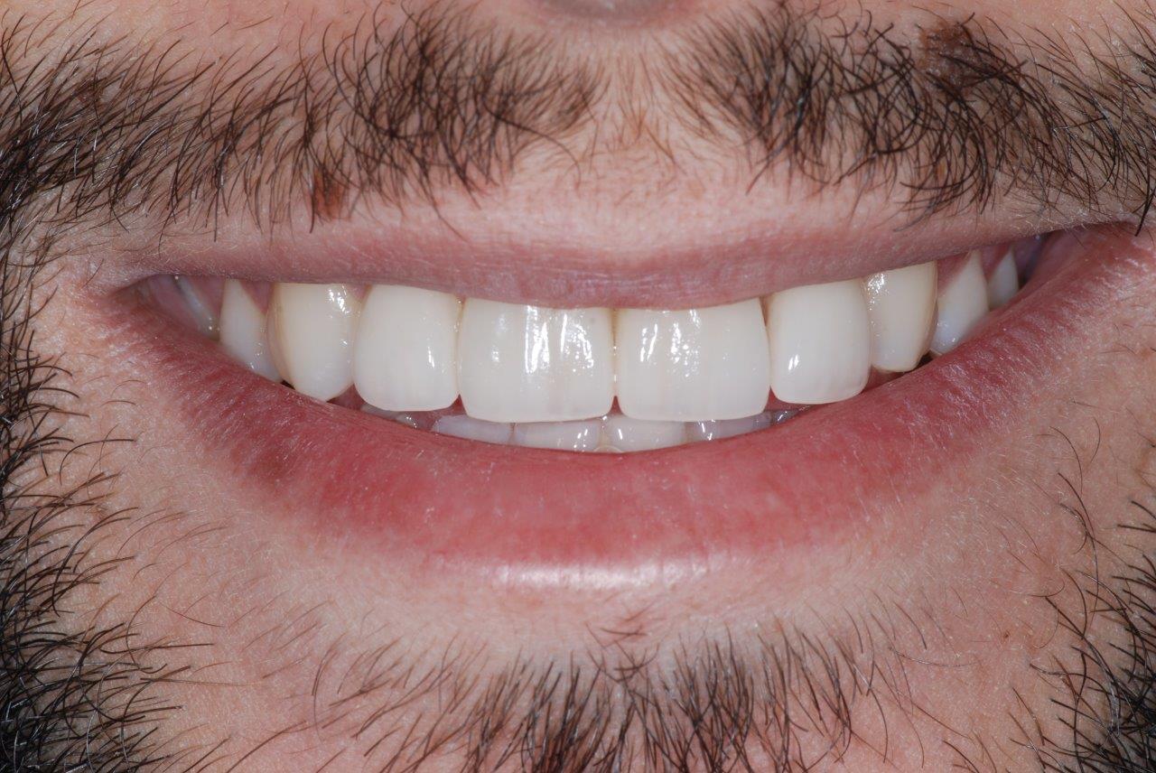 apre╠Çs pose de 4 facettes_