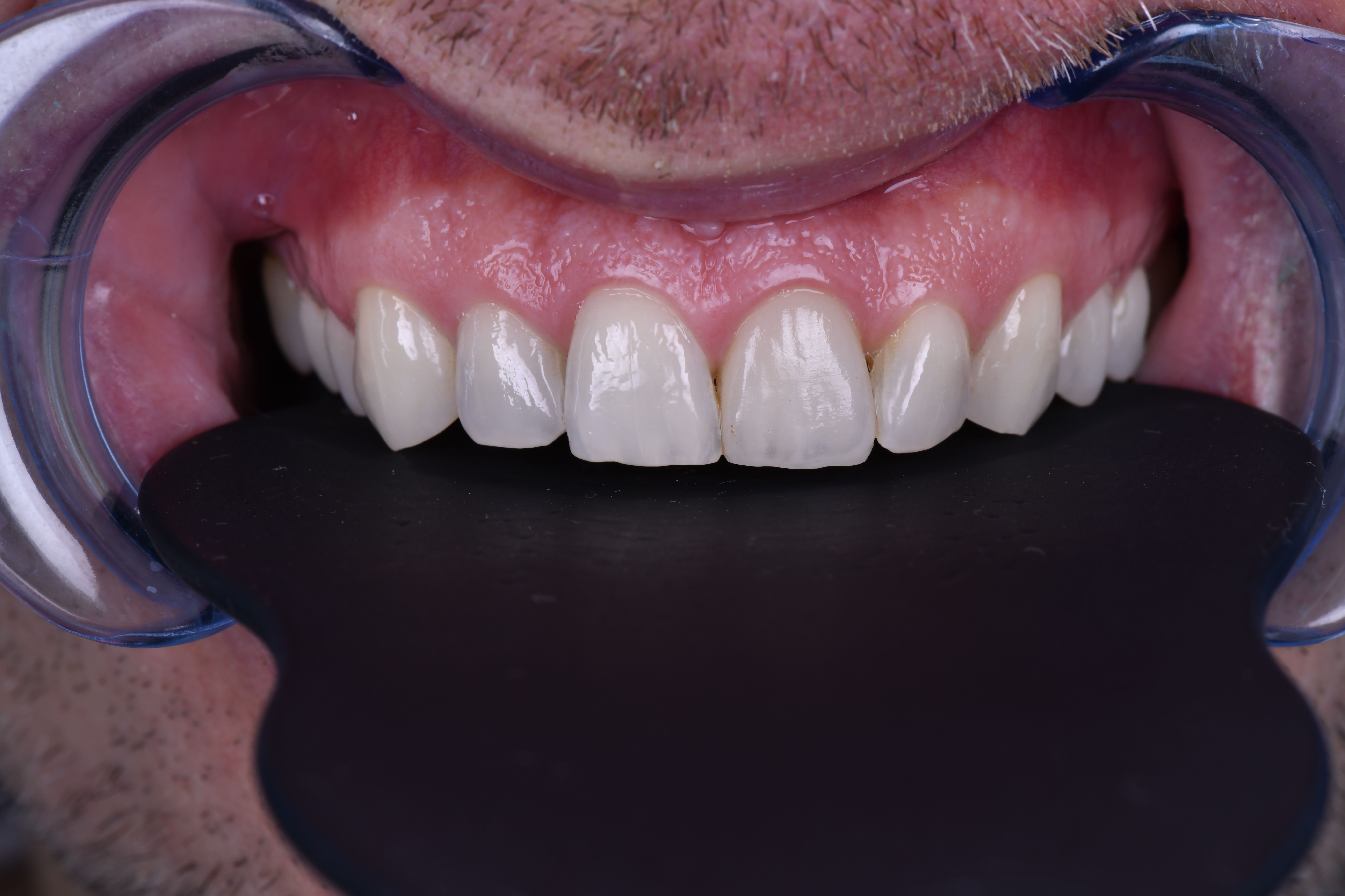 apre╠Çs pose de couronne 21