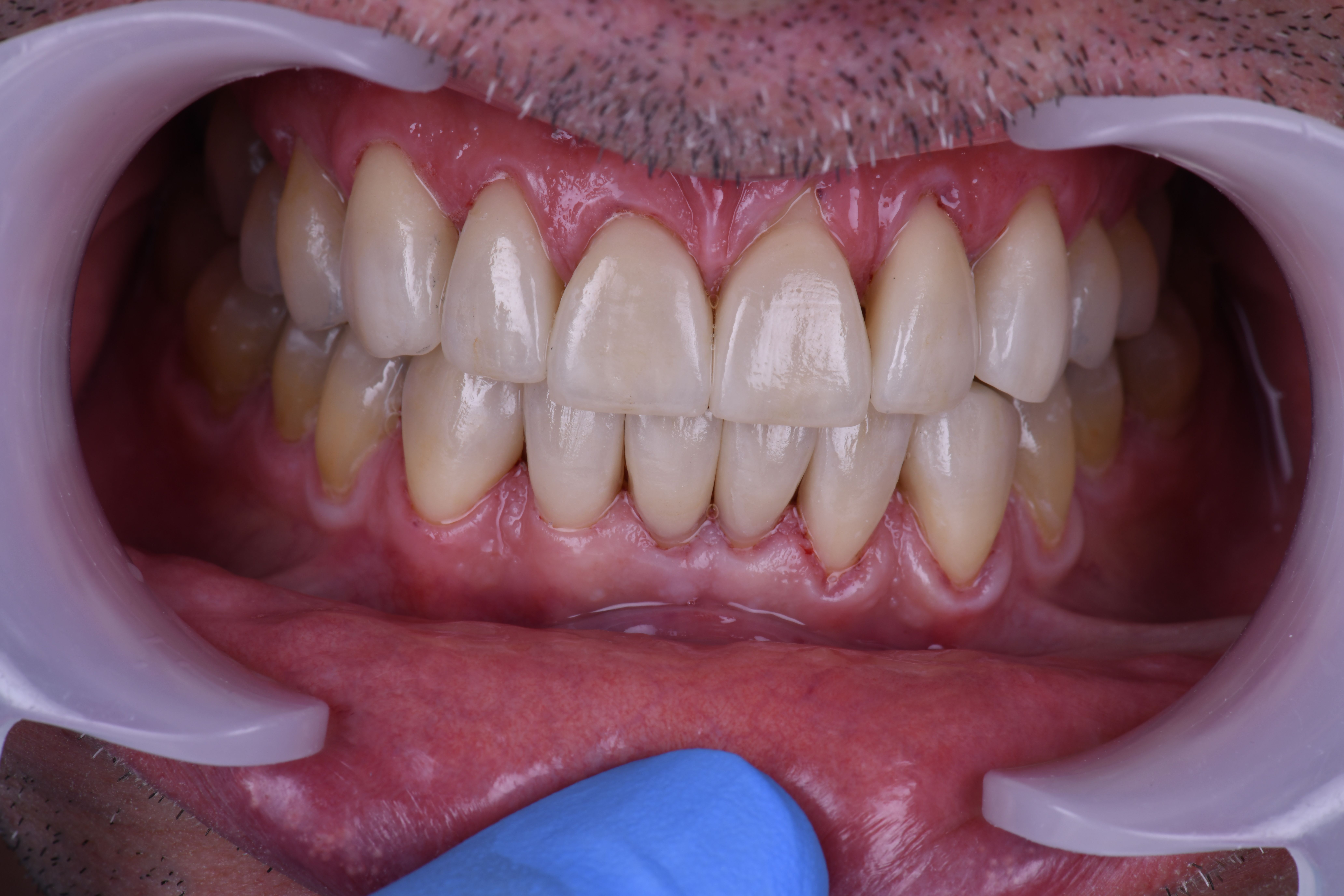 situation finale apre╠Çs pose de facettes et overlay_s